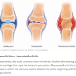 Anthritis